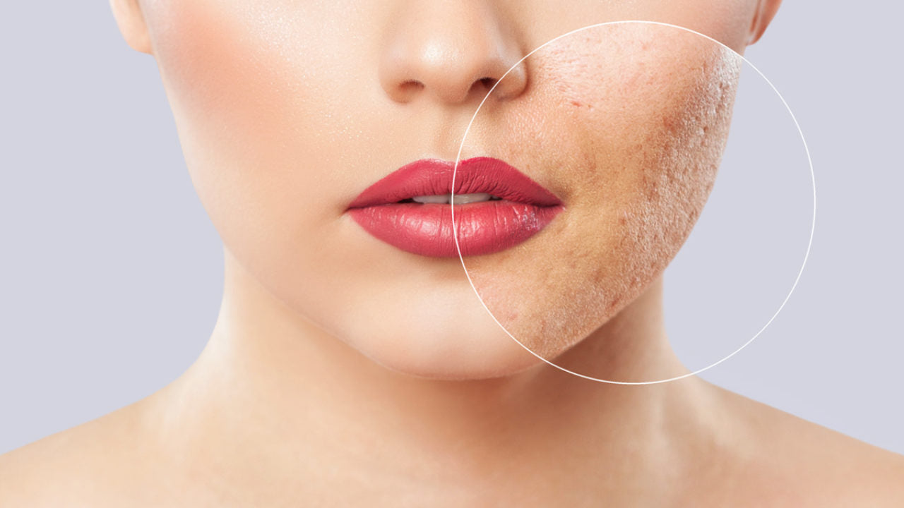 Come la fototerapia combatte l'acne