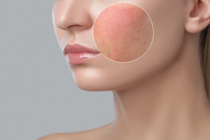 I Benefici della Fototerapia contro le Dermatiti